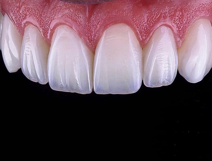 Fillings and Restorations